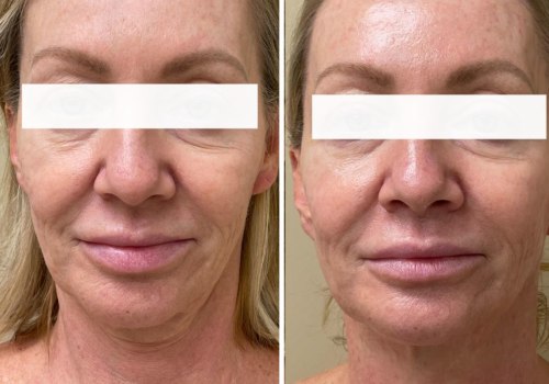What is the best laser treatment for a 60 year old woman?