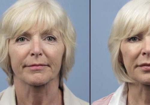 What is the best laser for a 60 year old?
