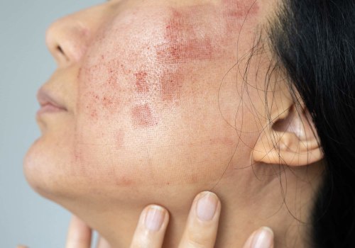 Can laser skin treatment go wrong?