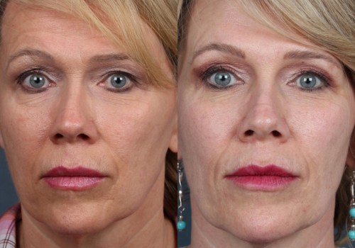 How often should i get laser skin resurfacing?