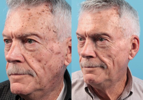 Are laser skin treatments worth it?