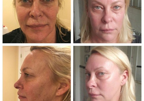 What is the best age for laser skin resurfacing?