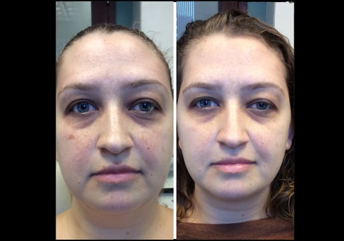 Is fraxel or co2 laser better for wrinkles?
