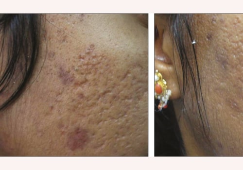 How much does laser treatment for skin cost?
