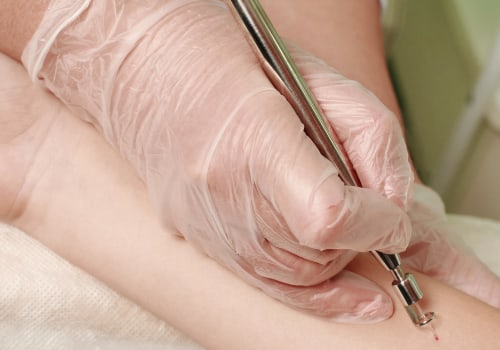 Can laser treatment be cancerous?