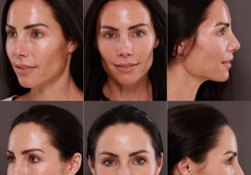 How long do skin laser results last?