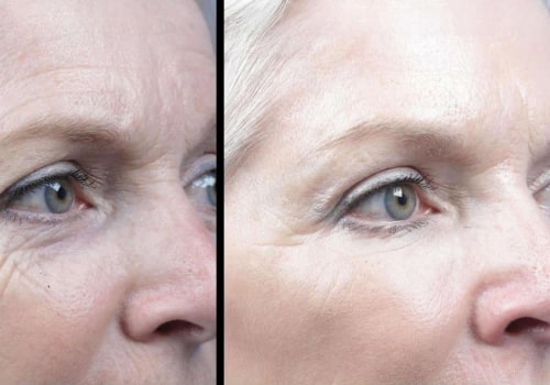Does co2 laser get rid of deep wrinkles?