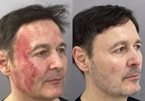 Can laser resurfacing cause skin cancer?