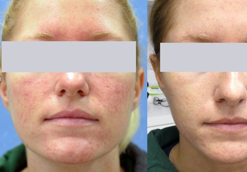 Does laser get rid of rosacea permanently?