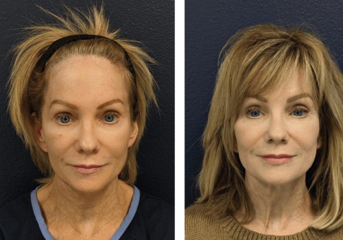 Do face lasers really make a difference?