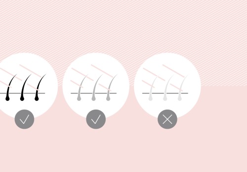 Who is not suitable for laser?