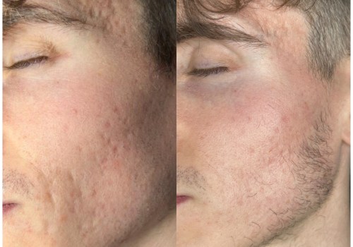 What age should you start laser resurfacing?