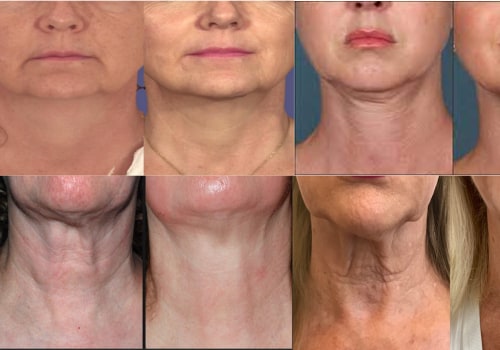 How long does laser neck tightening last?