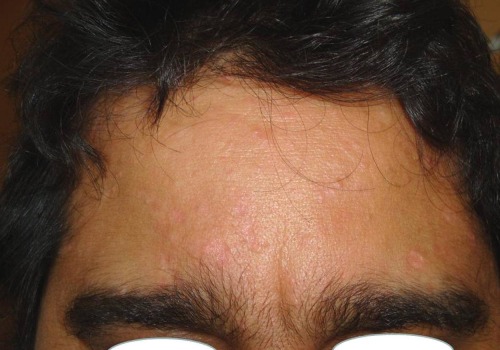 Pulsed Dye Laser (PDL): An Effective Treatment for Age Spots