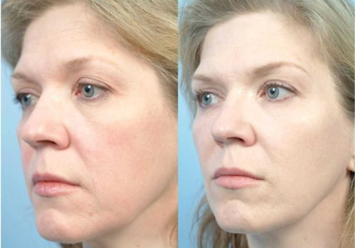 What's better, laser c02 or ultherapy for face?