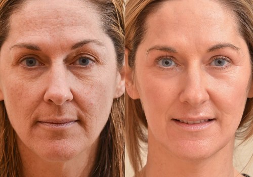 What is the best age for laser resurfacing?