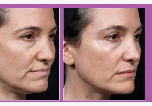 What is the best skin tightening procedure for over 60?
