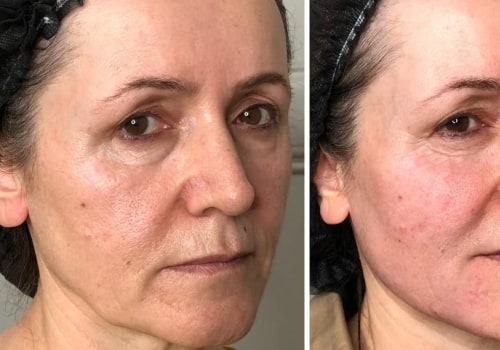Does co2 laser help with sagging jowls?