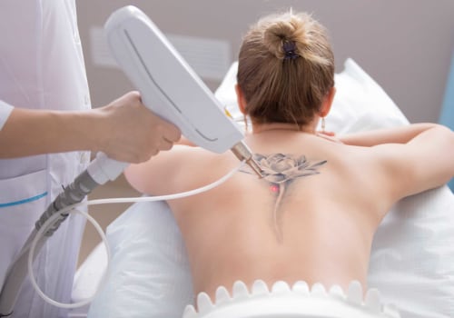 Is it normal to have a fever after laser tattoo removal?