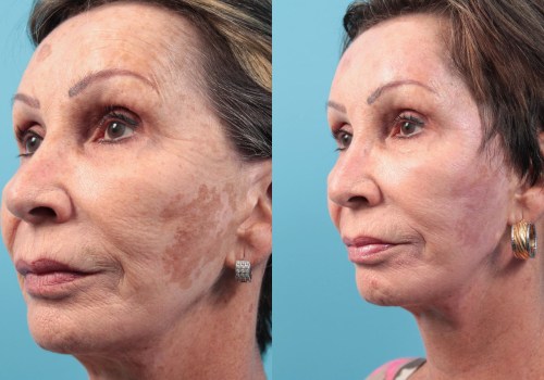 What is the strongest laser skin resurfacing treatment?