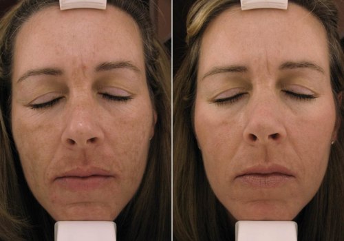 Laser Treatments for Melasma: An Overview of the Nd:YAG Laser