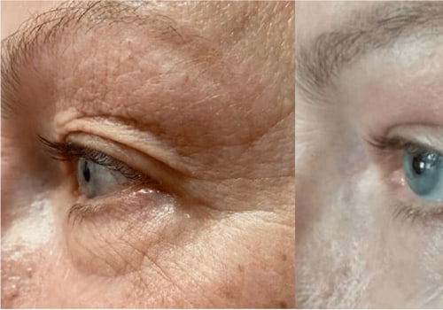 Is there anything better than co2 laser for wrinkles?