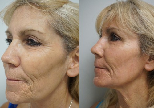 Is laser skin treatment risky?