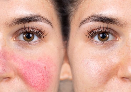 How to get rid of rosacea permanently?