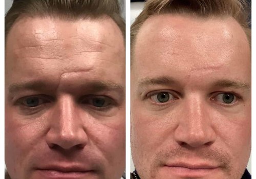 Does fraxel get rid of deep wrinkles?