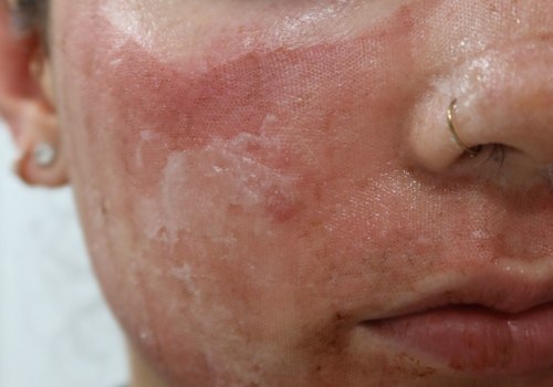 What are the bad results of laser resurfacing?