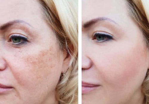 How often should you have a fraxel laser?