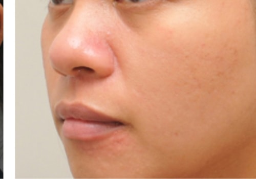 What are the disadvantages of laser on face?