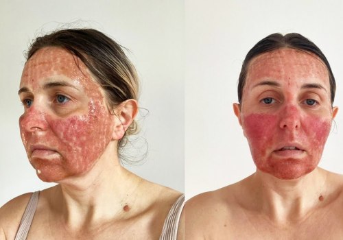 CO2 Laser Resurfacing: What You Need to Know