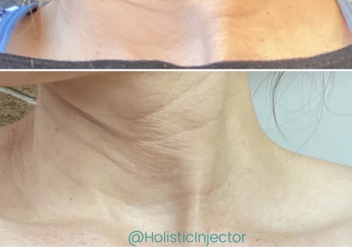 How long does skin tightening laser last?