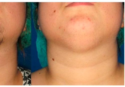 Are there negative effects of laser therapy?
