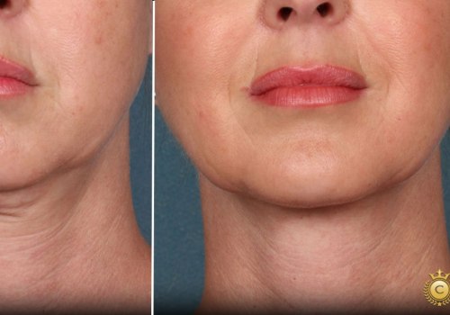 Does laser neck tightening work?