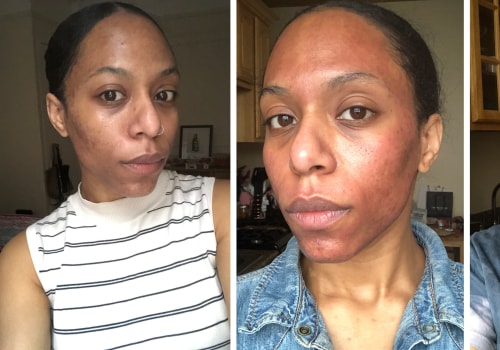 Is laser skin treatment worth the cost?