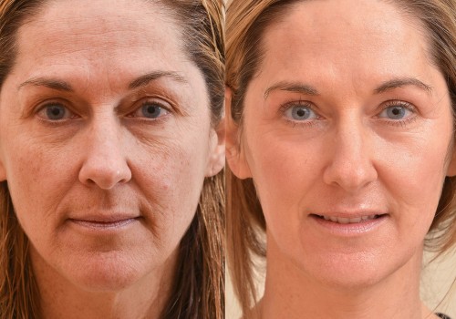 How long do laser skin tightening results last?