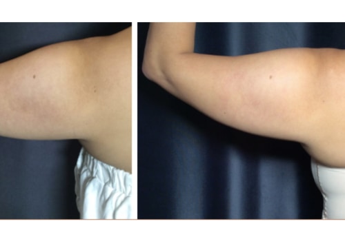 How much does laser skin tightening cost?