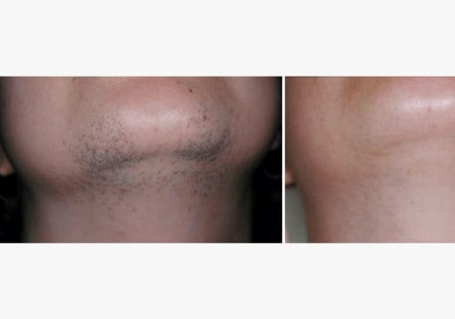 Is laser hair removal really worth it?