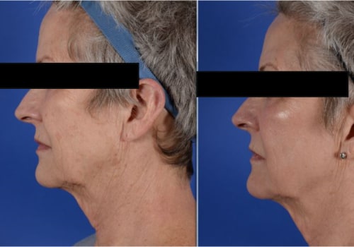 Who is not a good candidate for laser resurfacing?